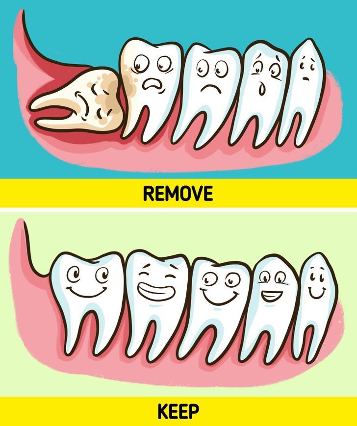 What Happens If You Don’t Remove Wisdom Tooth? Risks & When to Act (2026)