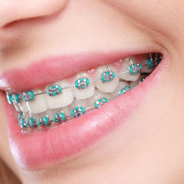Can You Get Braces After 40? Adult Braces Guide in Johor Bahru (2026)