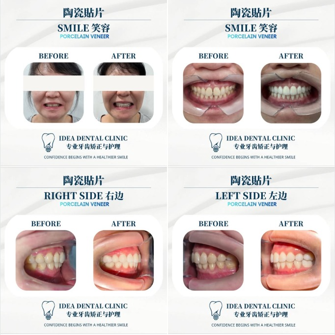 Veneers Before and After: Realistic Smile Results in JB