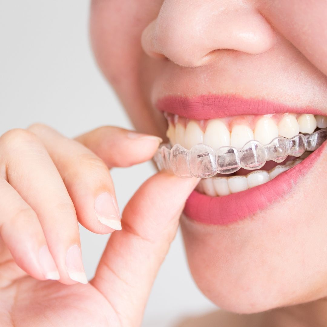 What Foods Cannot Eat With Clear Aligner? Complete Guide in Johor Bahru (2026)