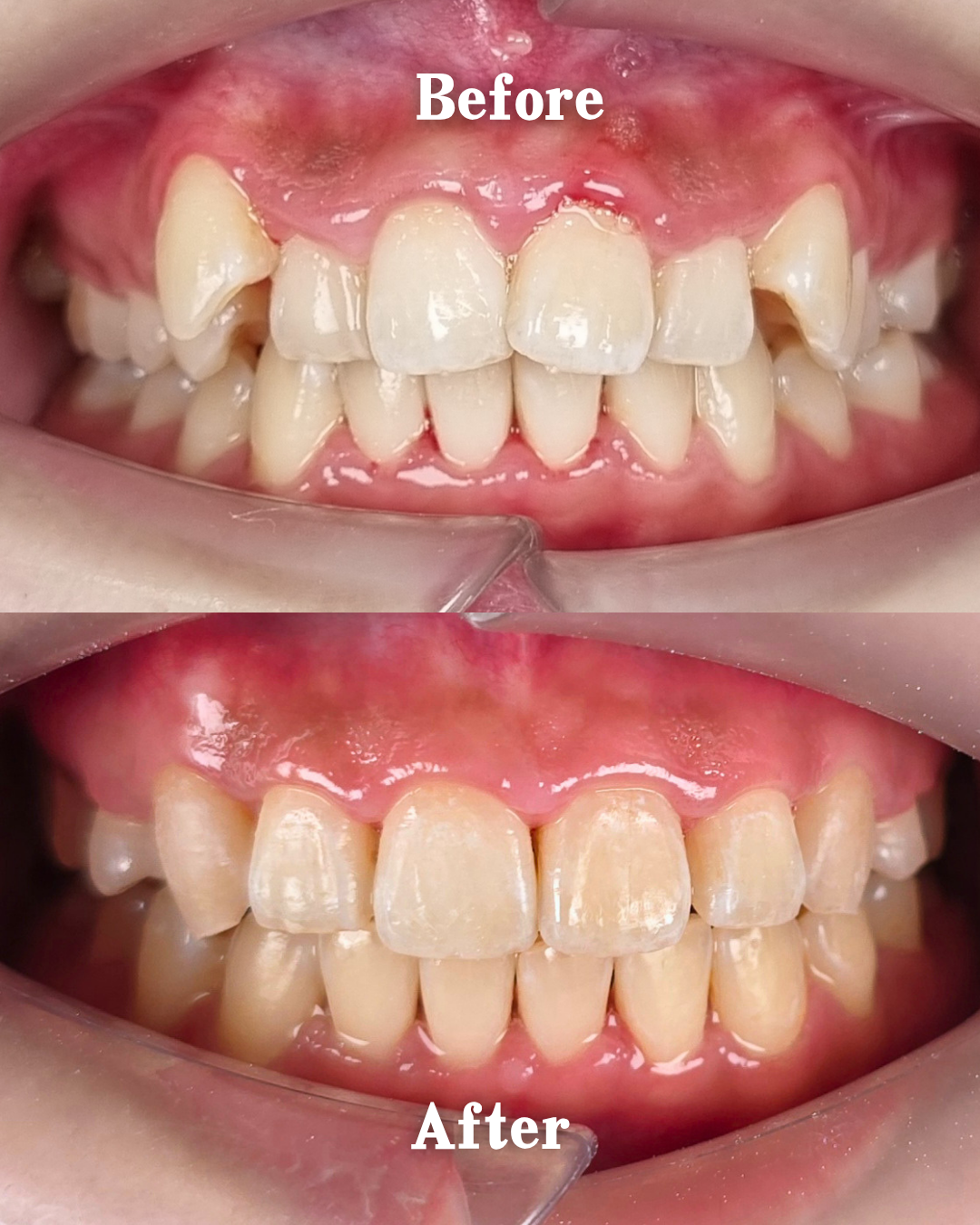 Can Clear Aligner Fix Crooked Teeth? Invisible Teeth Straightening in Johor Bahru (2026)