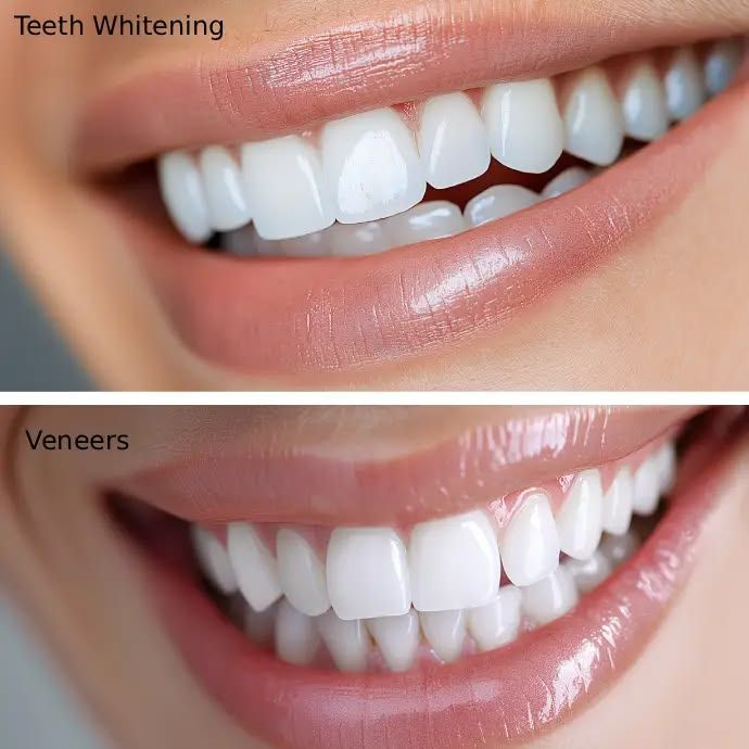 Veneer vs Teeth Whitening: Which Is Better for Your Smile in Johor Bahru?