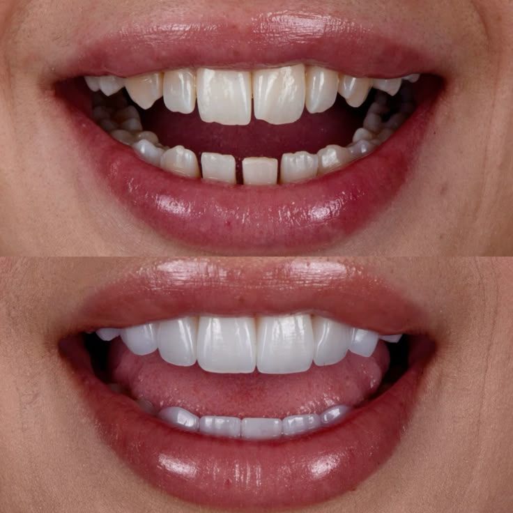 Do Veneers Look Fake? How Natural Veneers Look Today in Johor Bahru