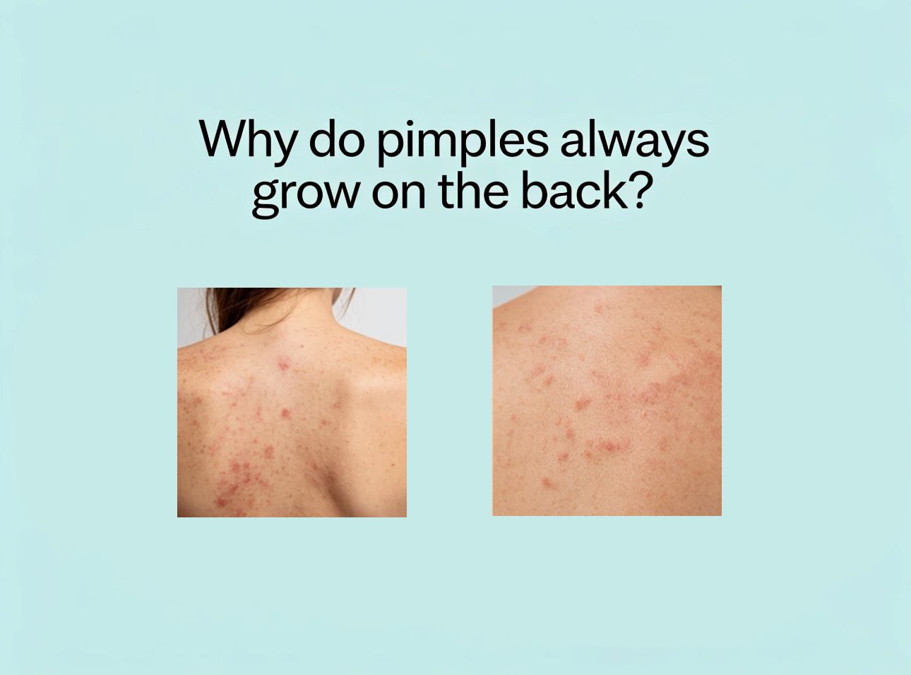 Why Do Back Pimples Keep Coming Back?