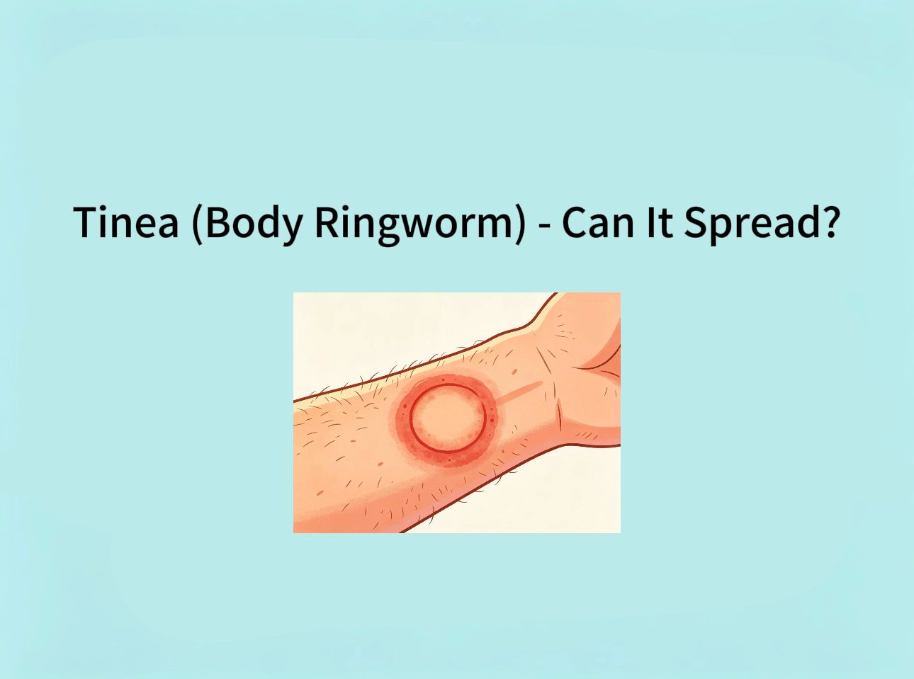 Tinea (Body Ringworm) — Can It Spread?