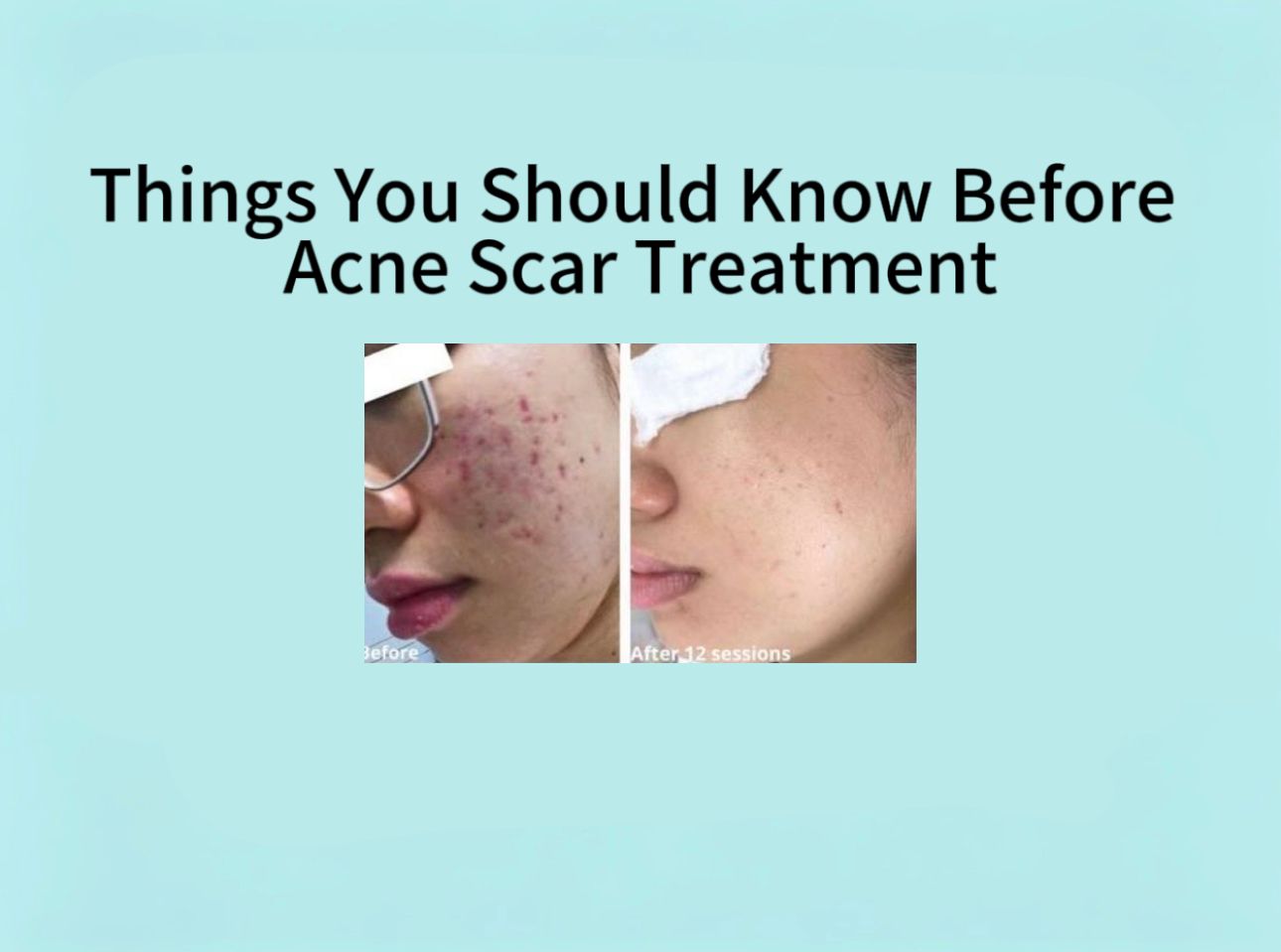  Things you should know before acne scar treatment