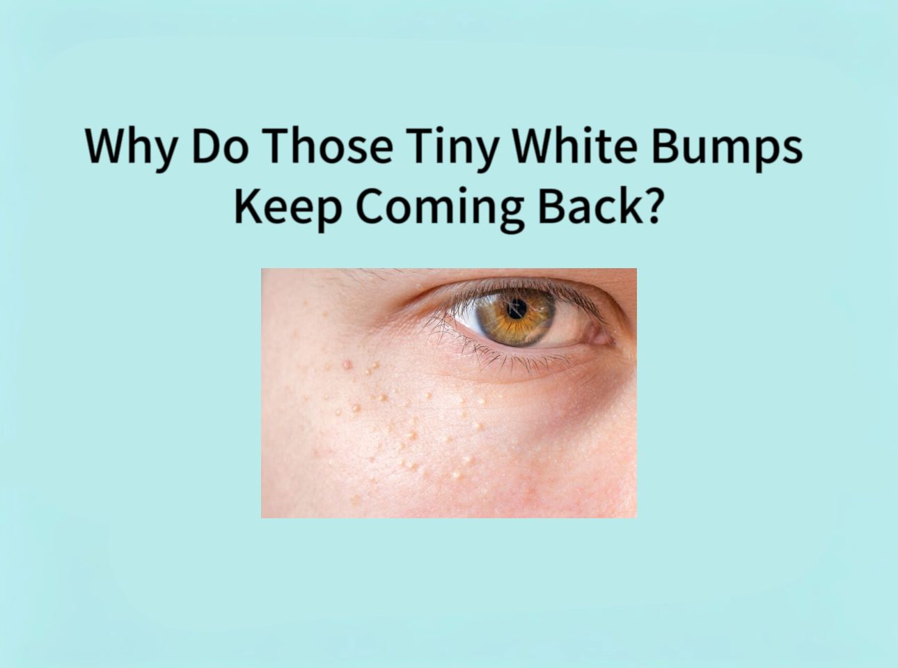 WHY DO THOSETINY WHITE BUMPS KEEP COMING BACK?