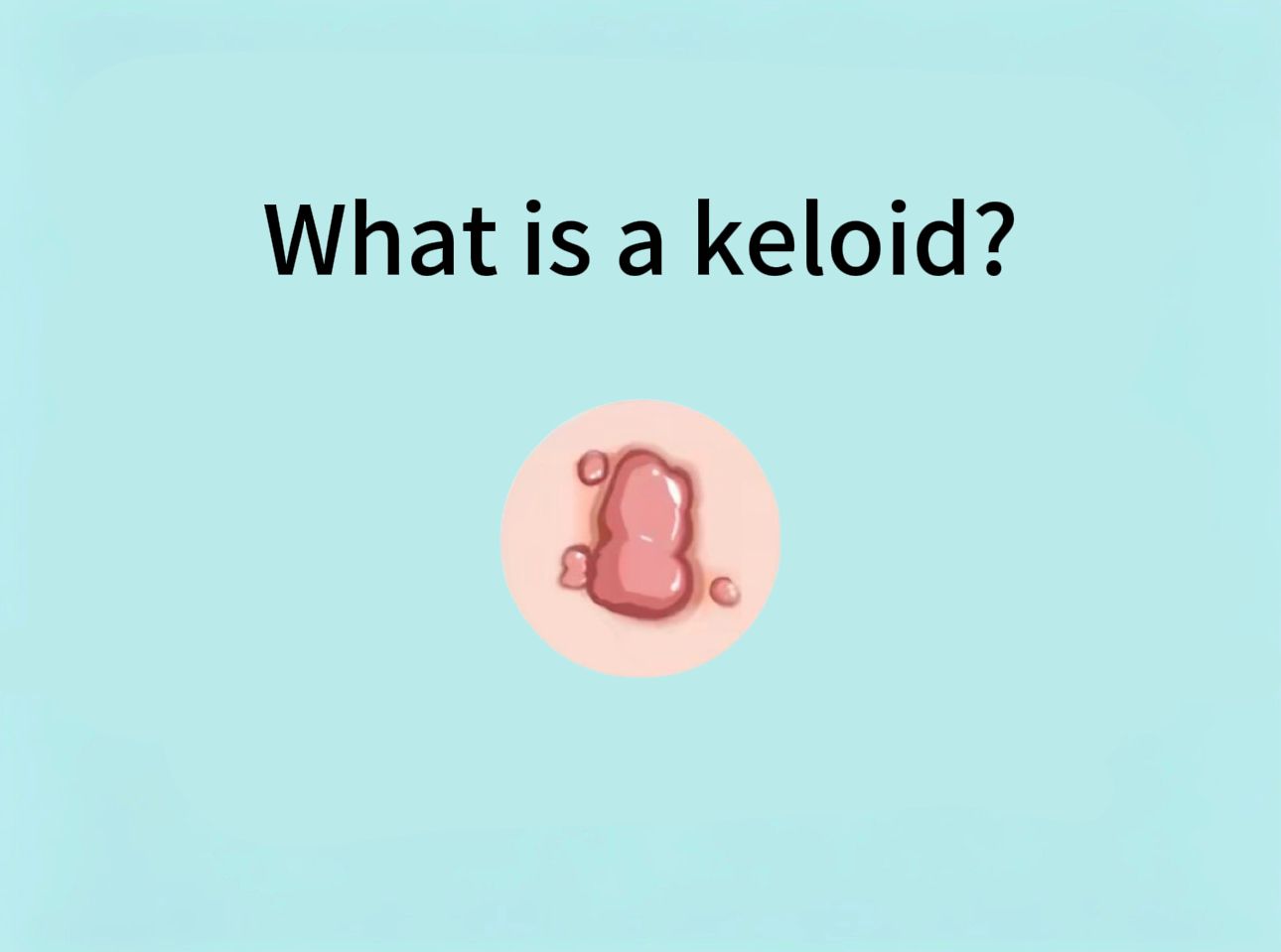 What Is a Keloid?