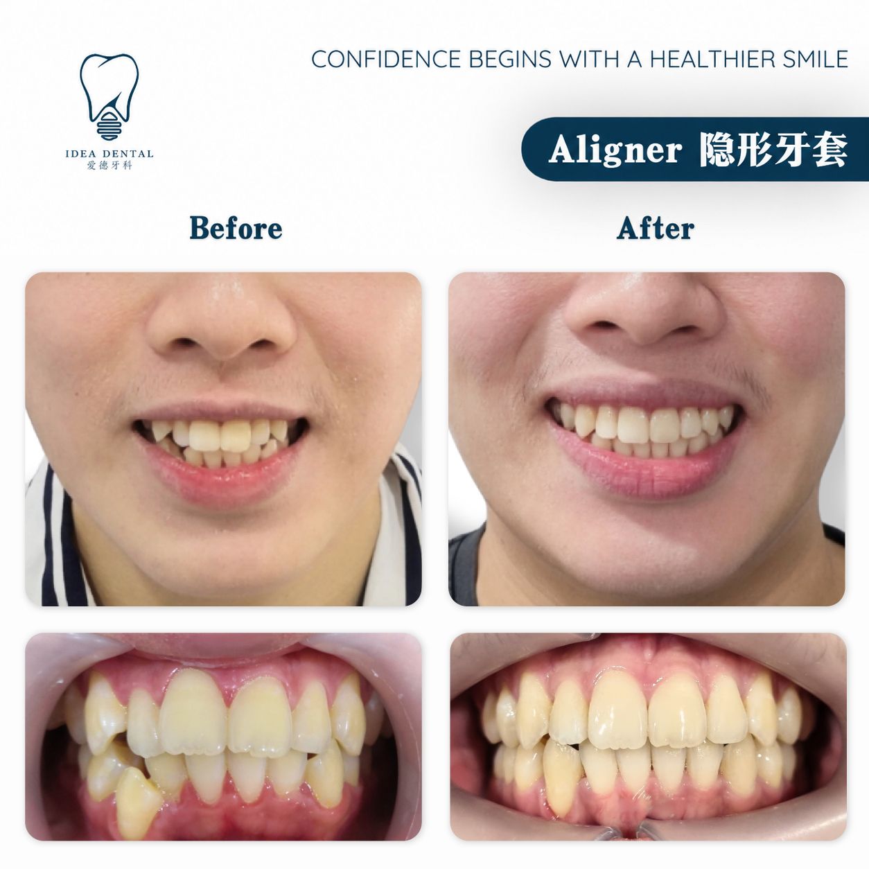 Aligner 隐形牙套
