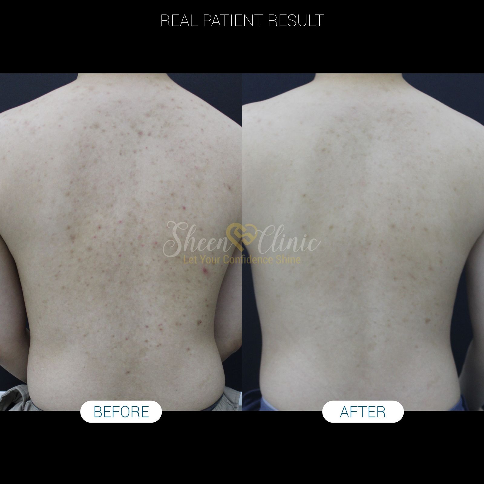 The International Student’s Guide to Treating Sudden Back Acne (Bacne) in Malaysia