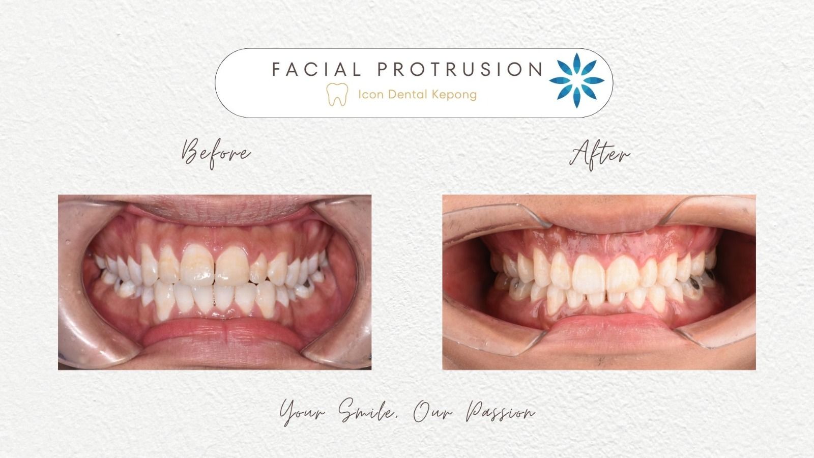Invisalign
