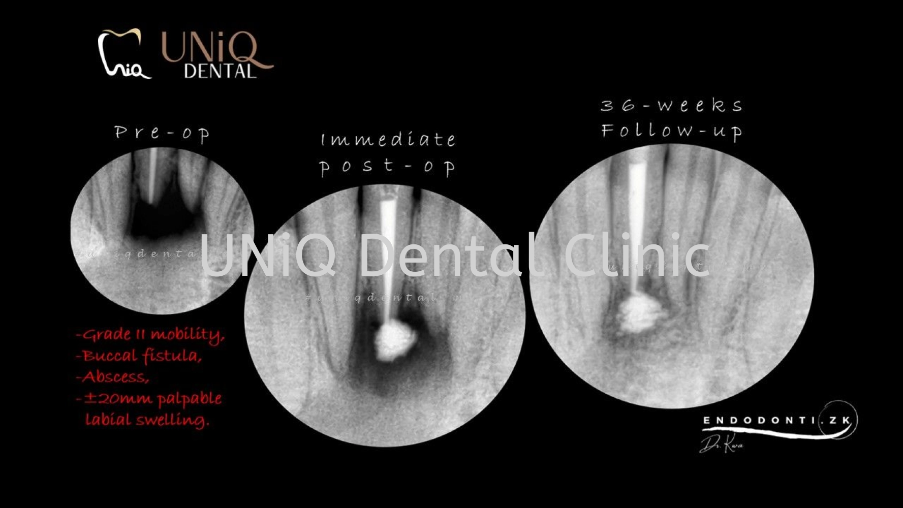 Root Canal Treatment