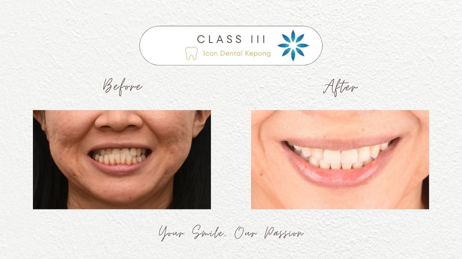 Invisalign