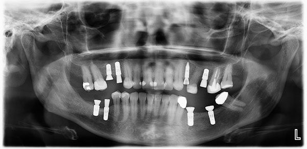 Dental Implants 