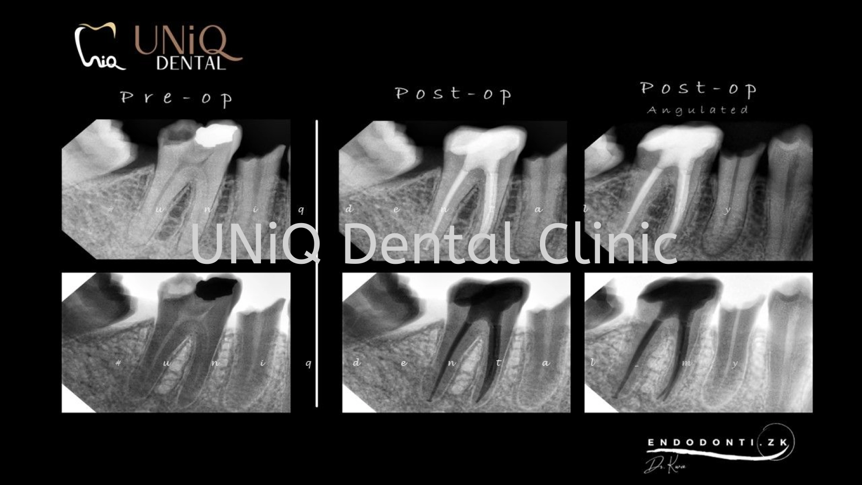 Root Canal Treatment