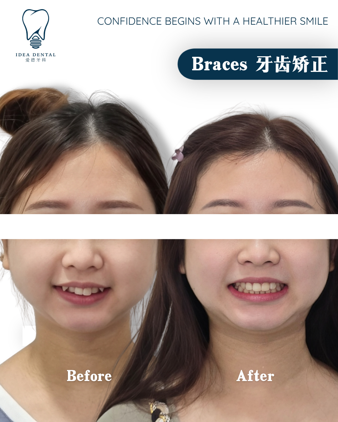 Effective Woman Braces