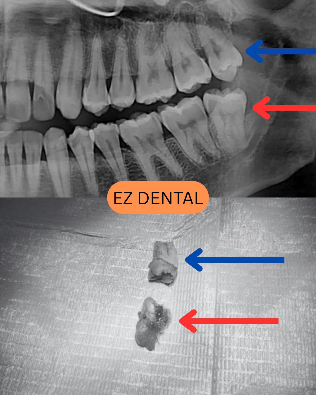 Wisdom Tooth Removal Seri Kembangan