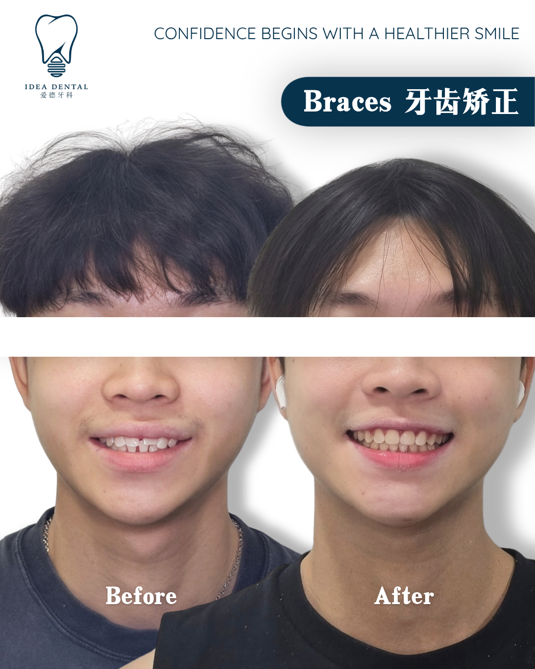 Male Braces Pelangi