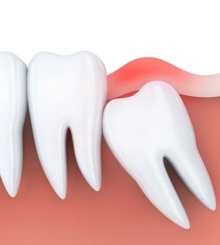 Wisdom Tooth Removal Surgery