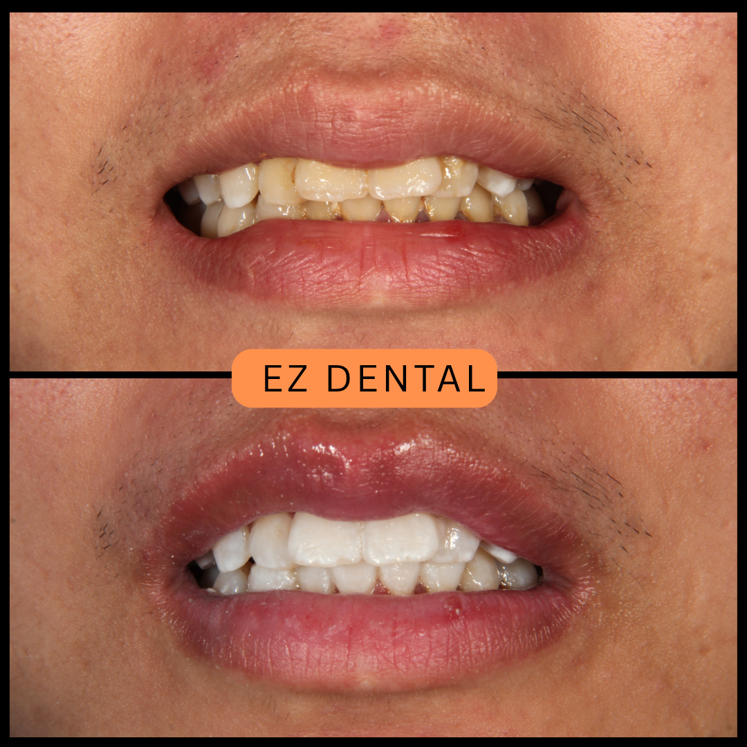Teeth Whitening