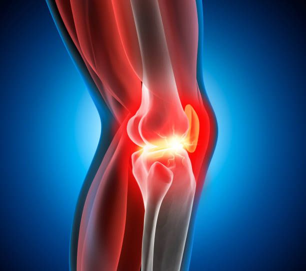 Stages of Knee Osteoarthritis