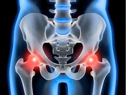 Hip Osteoarthritis: Understanding, Managing, and Exploring Treatment Options