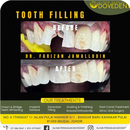 Tooth Filling's Logo