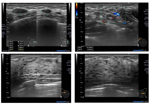 Breast Scan