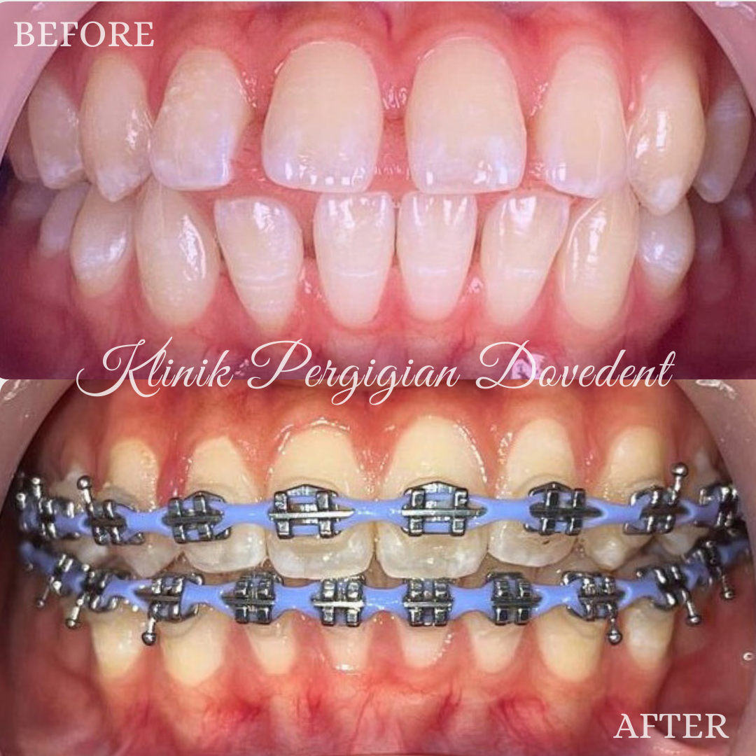 Braces Conventional