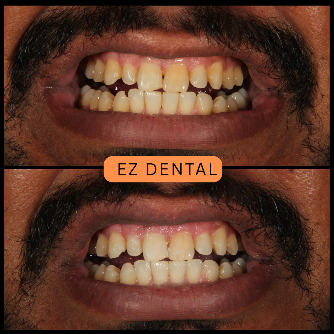 Whitening