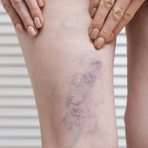 Spider Veins Treatment