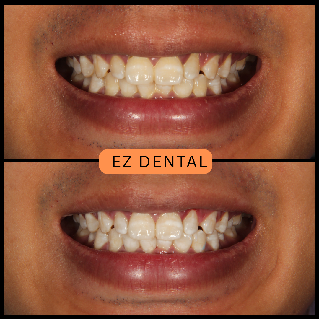 Teeth Whitening