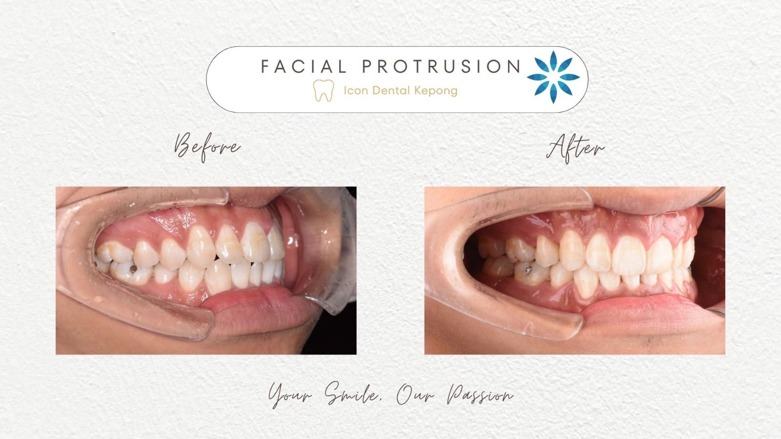 Invisalign