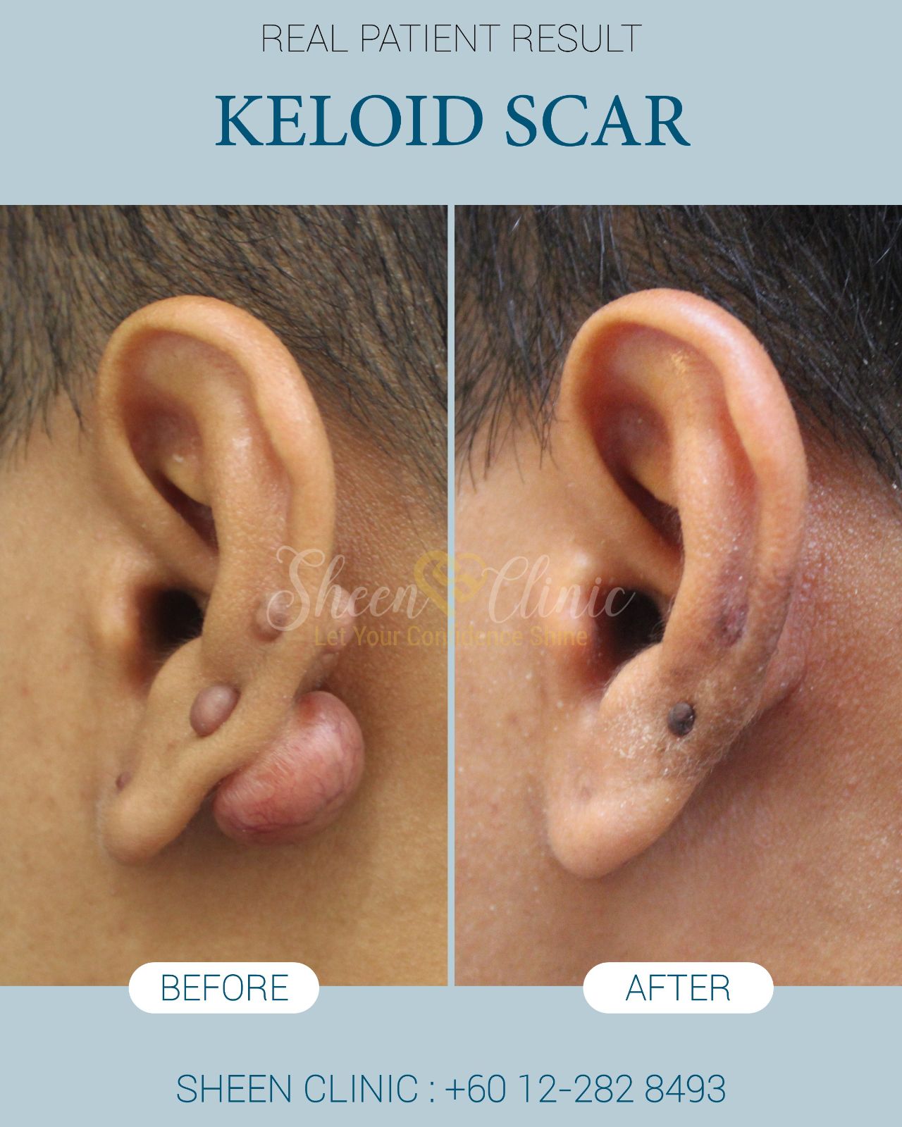 Keloid Treatment in Subang Jaya, Selangor