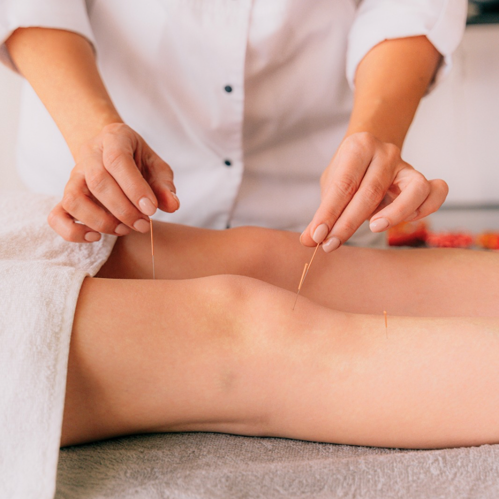 中医针灸治疗 TCM Acupuncture Therapy