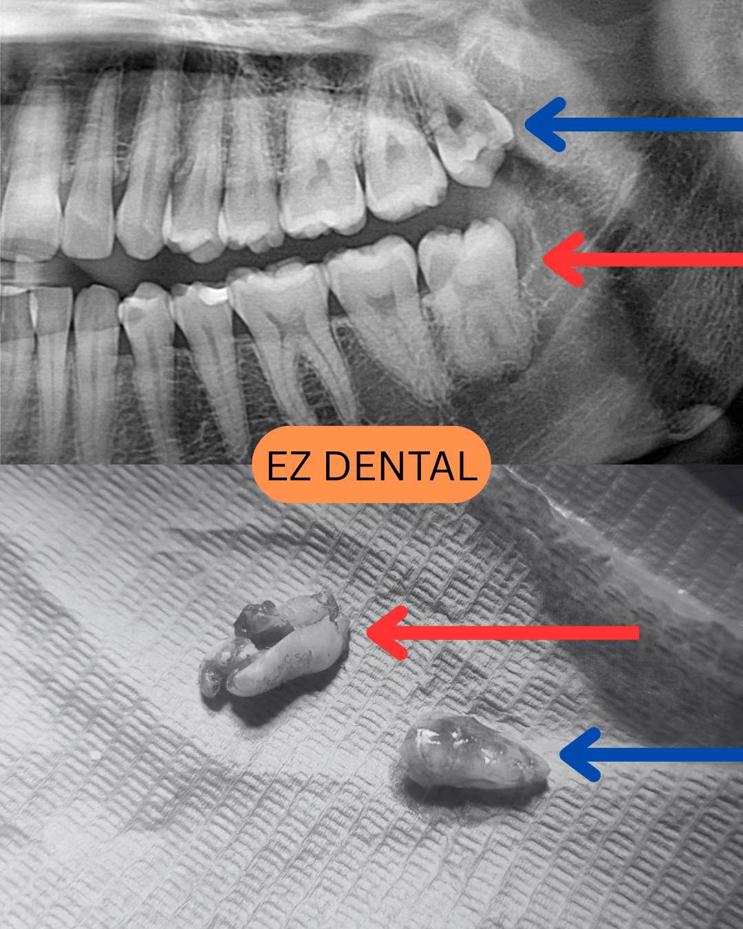 Wisdom Tooth Surgery