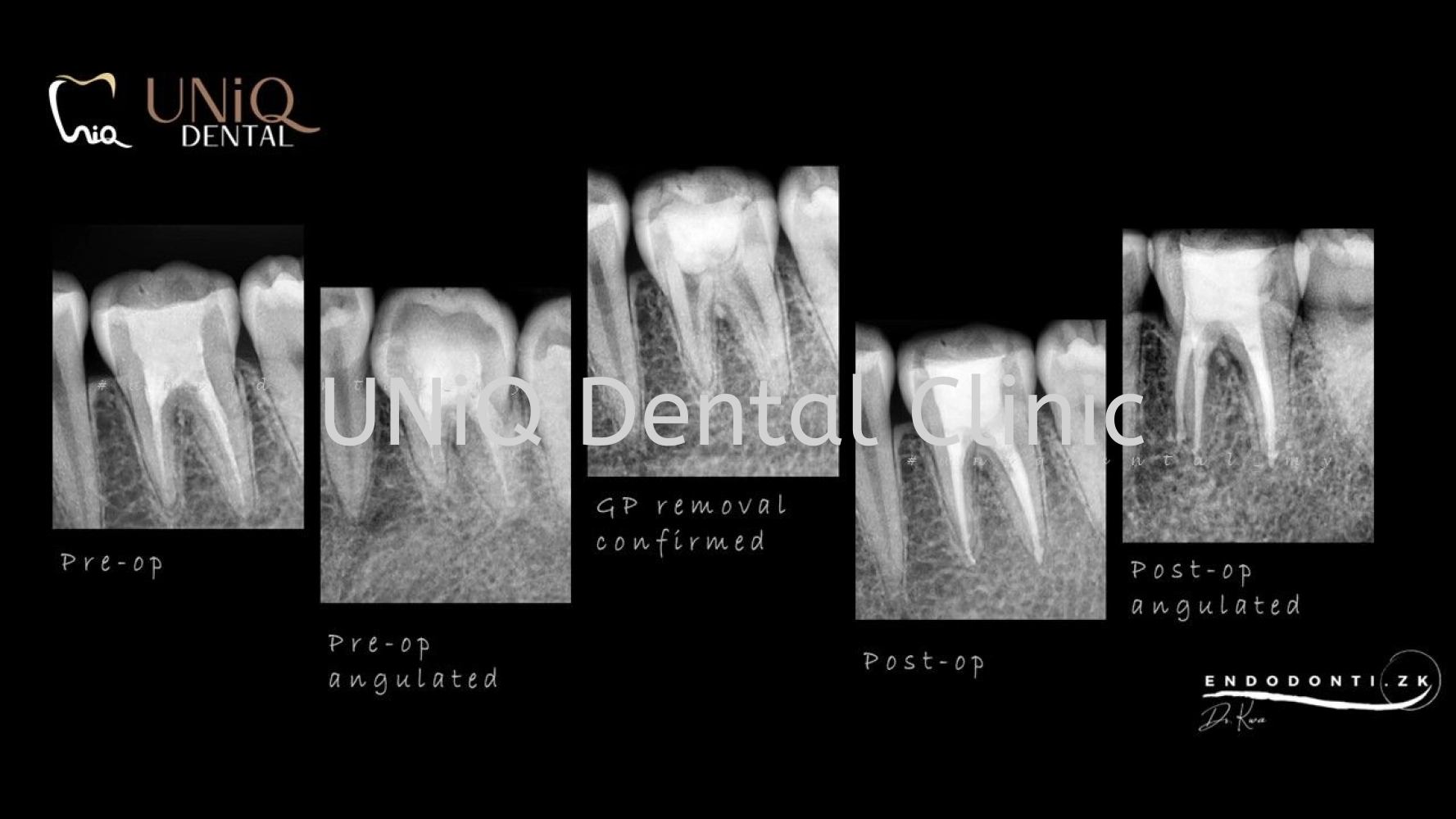 Root Canal Treatment