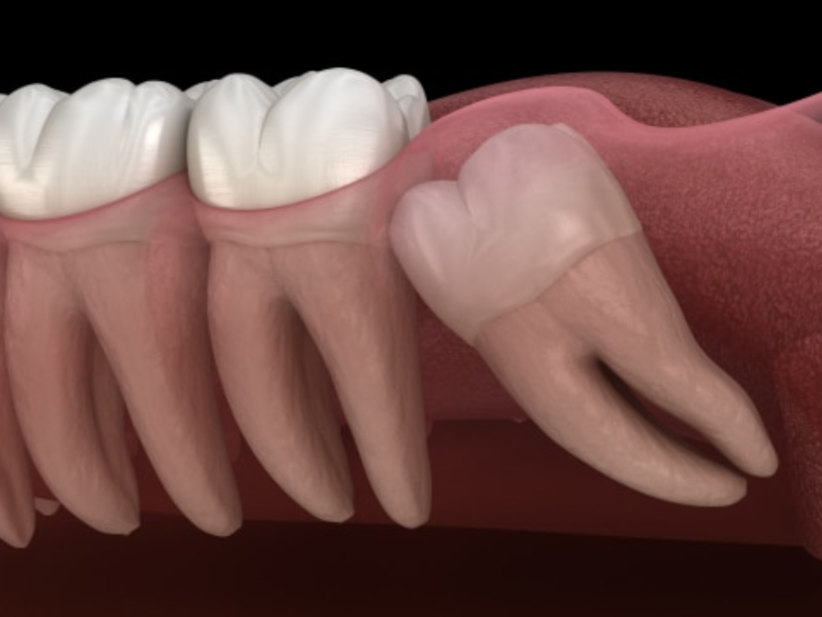 Wisdom Tooth Removal