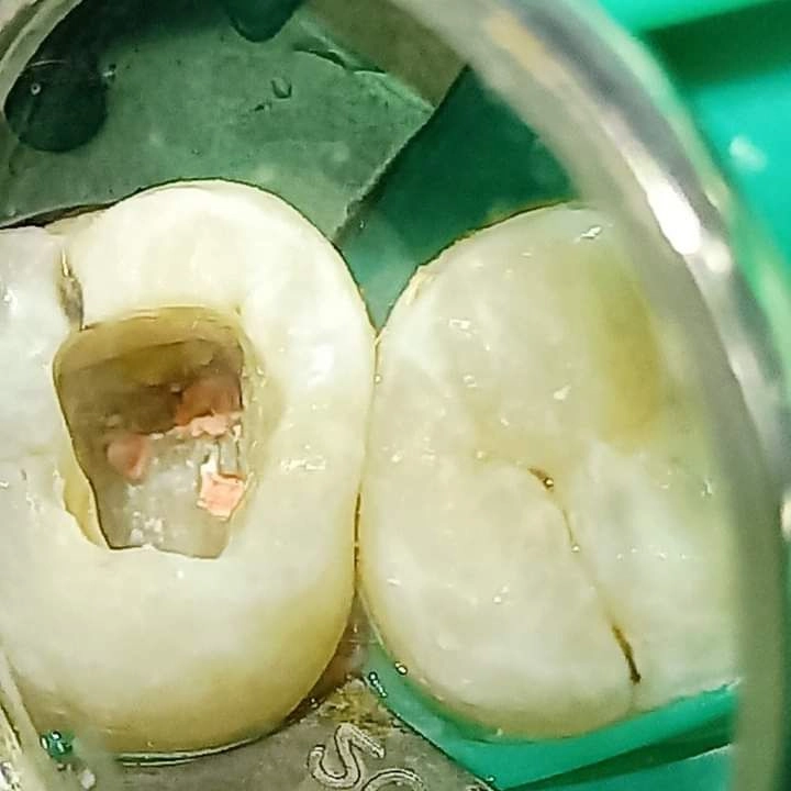 Root Canal Treatment