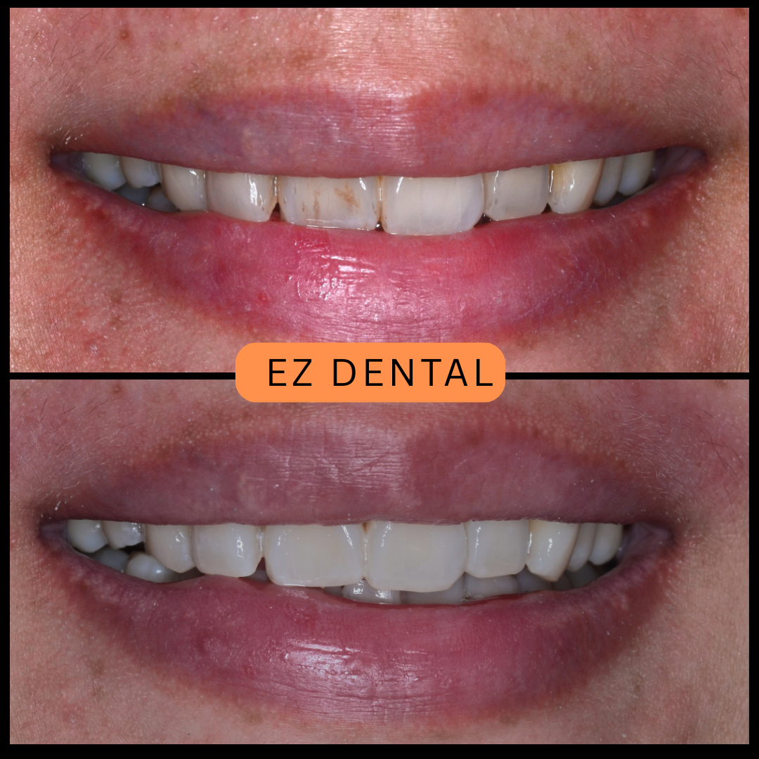 Teeth Whitening