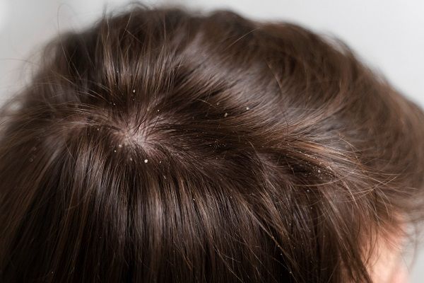 Severe Dandruff Solutions