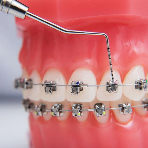 Self Ligating Braces (Metal)