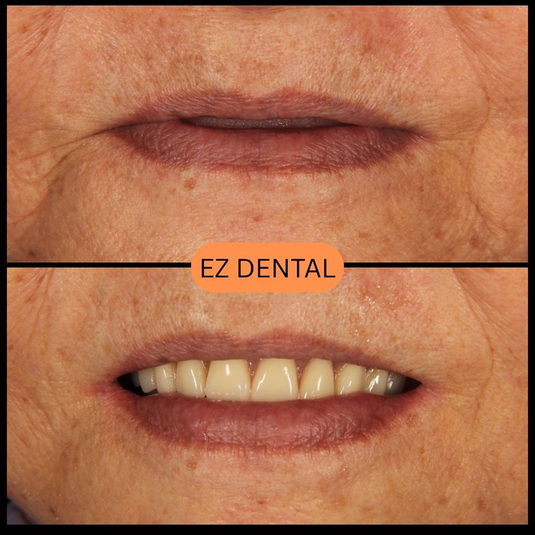Denture