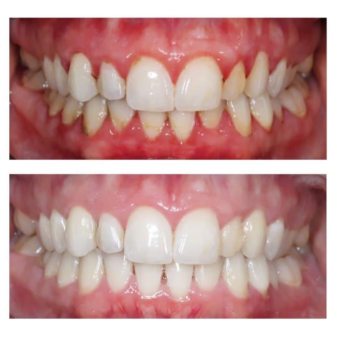 Root Planning/ Gum surgery