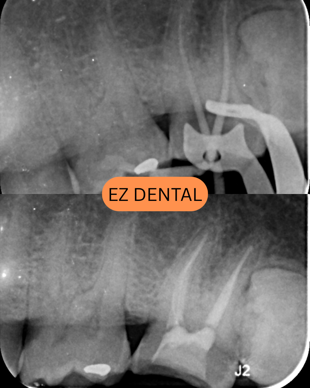 Root Canal Treatment