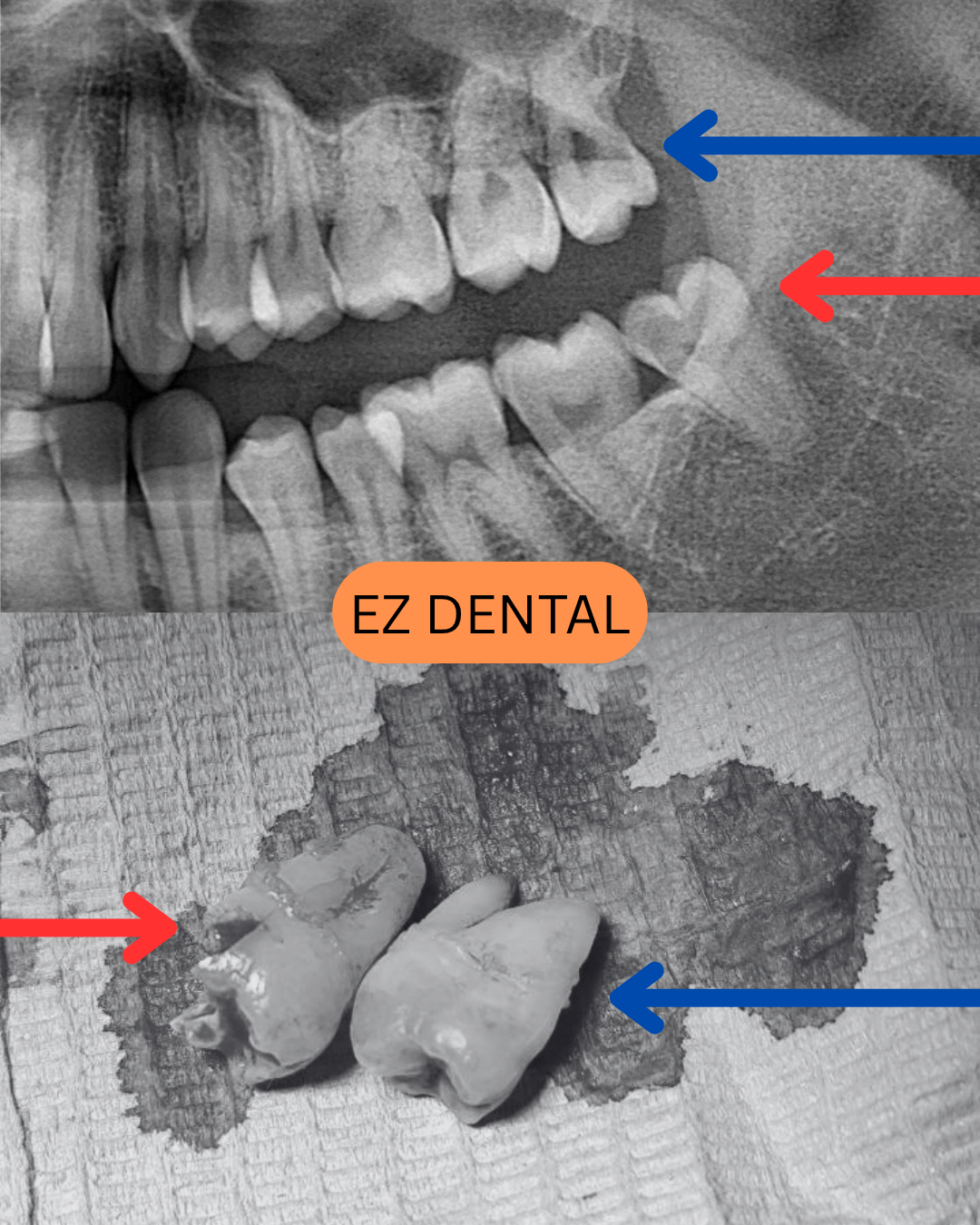 Wisdom Tooth Surgery