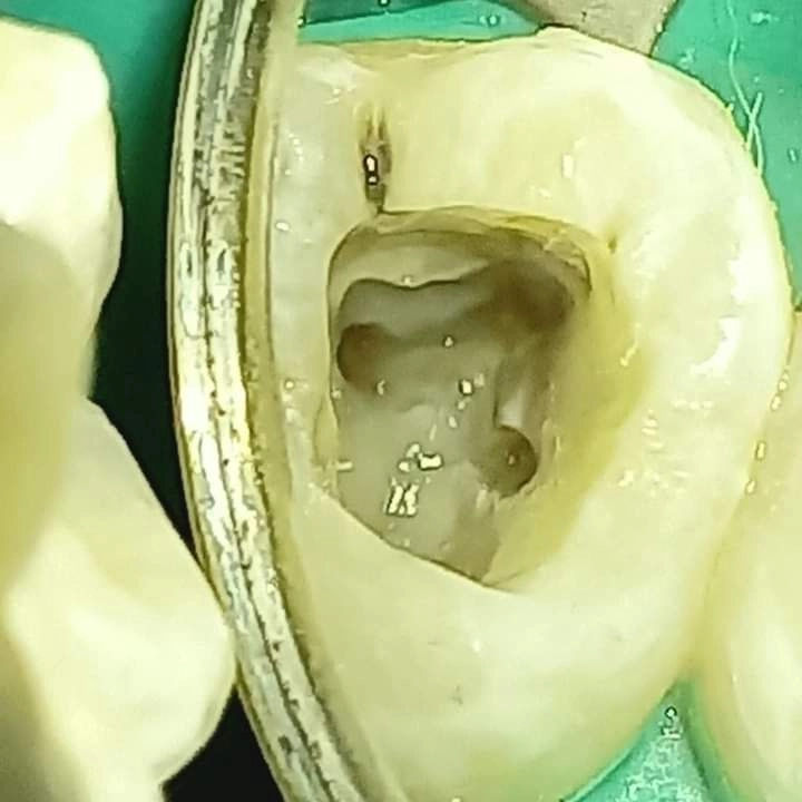 Root Canal Treatment