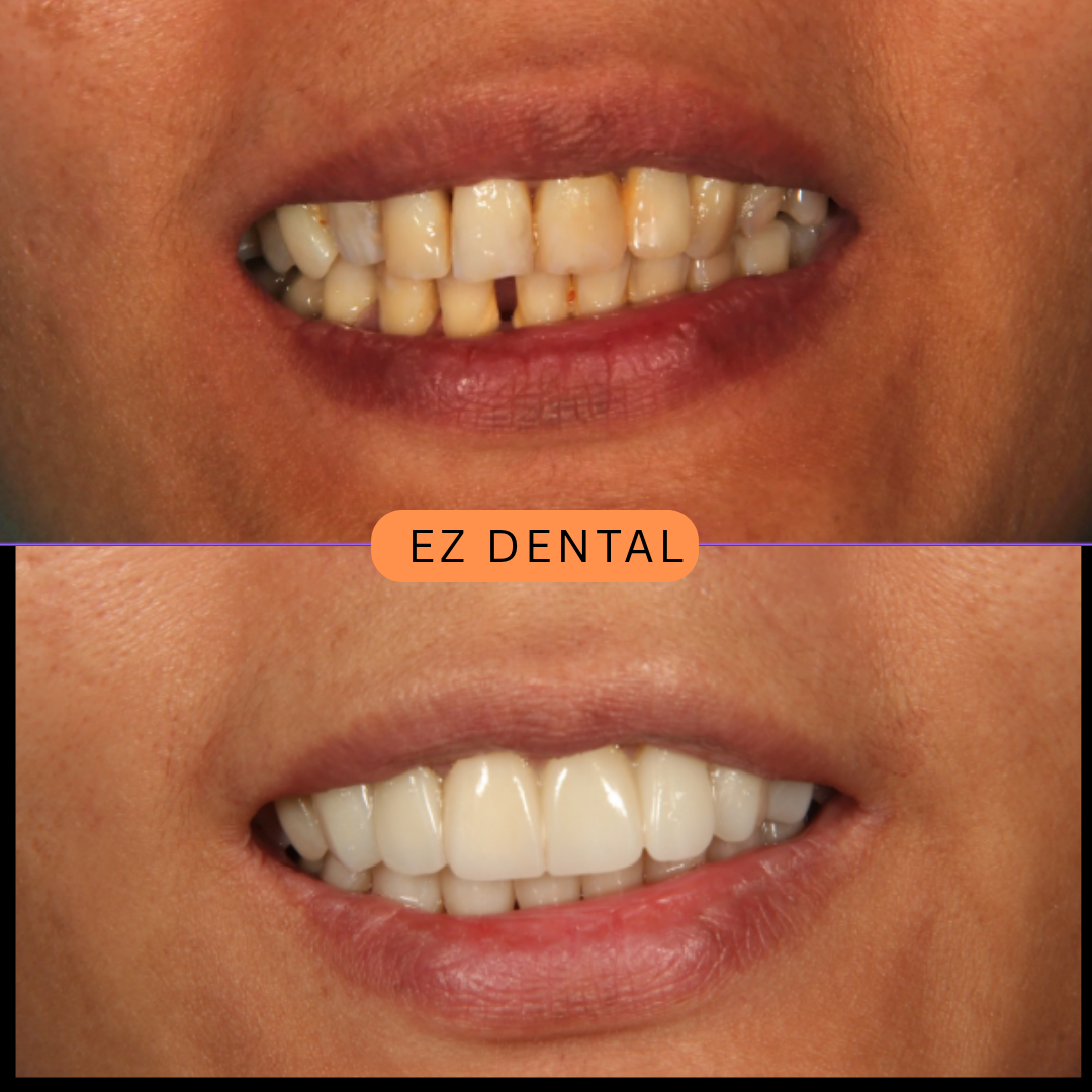 Veneers Smile Transformation | Seri Kembangan