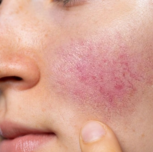 Broken Capillaries Treatment