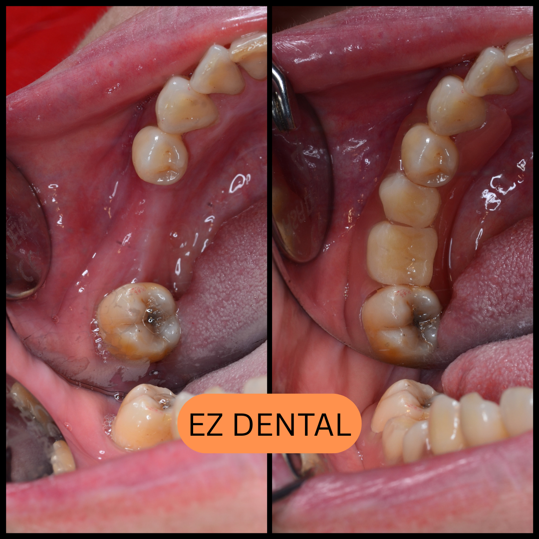 Denture